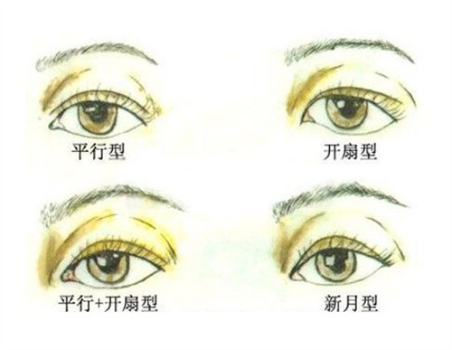双眼皮类型图