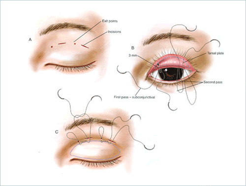 双眼皮手术流程操作示意图
