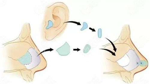 耳软骨隆鼻图片