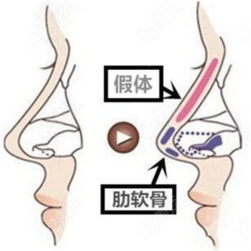 假体隆鼻内部图片