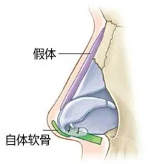 隆鼻示意图