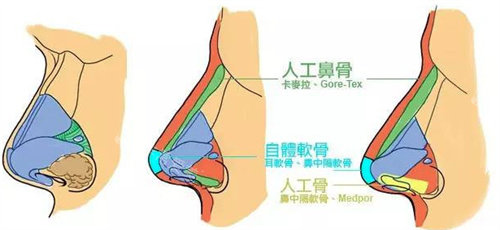 隆鼻形态图