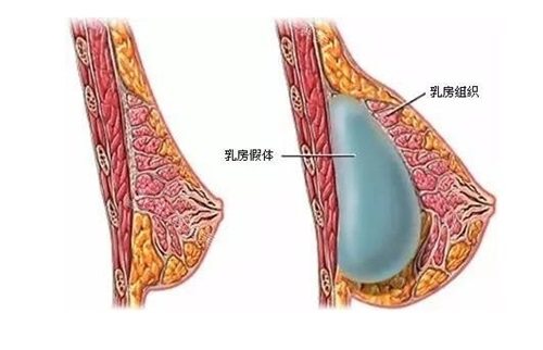 乳房假體位置示意圖 乳房假體位置示意圖