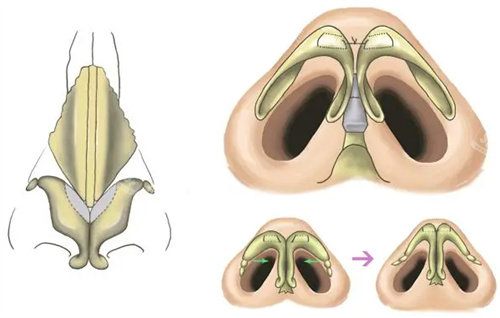 蒜头鼻手术操作图