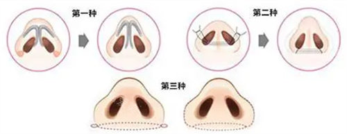 蒜頭鼻示意圖 蒜頭鼻示意圖