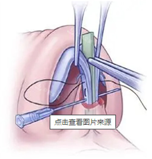 蒜头鼻手术操作图