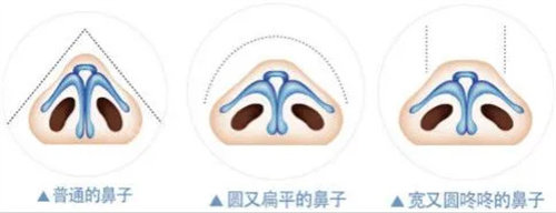 蒜頭鼻形態(tài)圖 蒜頭鼻形態(tài)圖