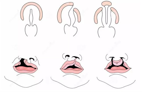 唇腭裂三种不同程度展示图