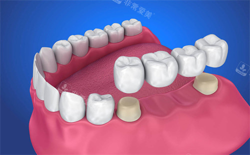 連橋冠修復(fù)圖示