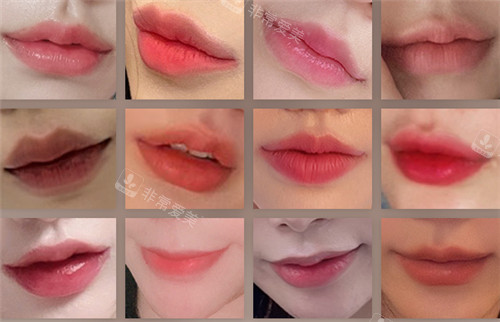 韩国Avant整形外科唇部整形术后展示图