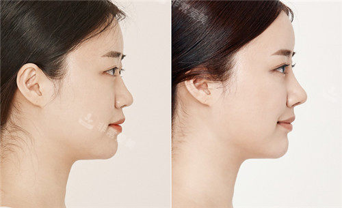 韩国om整形外科女鼻整形图
