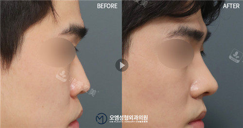 韩国整鼻子好的小众医院分享，OM整形男鼻女鼻都很惊艳！