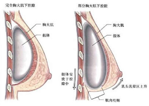 假體隆胸結(jié)構(gòu)圖