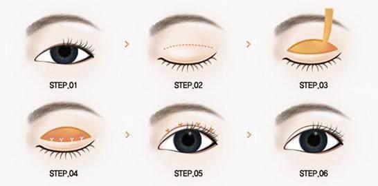 双眼皮手术流程图