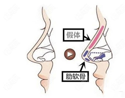 隆鼻结构展示图