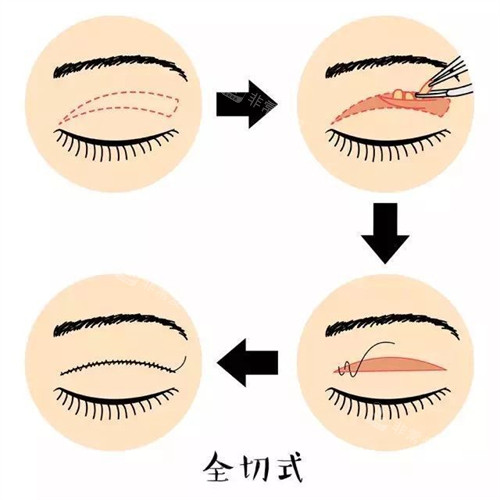 全切式雙眼皮手術(shù)流程圖 全切式雙眼皮手術(shù)流程圖
