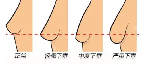 胸部下垂程度示意圖 胸部下垂程度示意圖