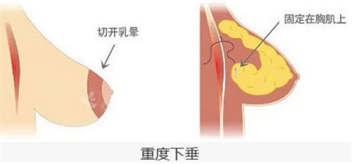 乳房矫正手术示意图