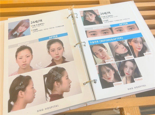 韓國(guó)GNG整形手術(shù)圖片相冊(cè) 韓國(guó)GNG整形手術(shù)圖片相冊(cè)