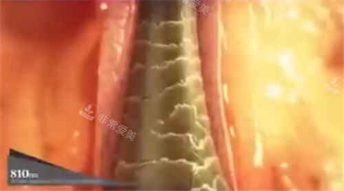 titanium鈦提升810波長(zhǎng)