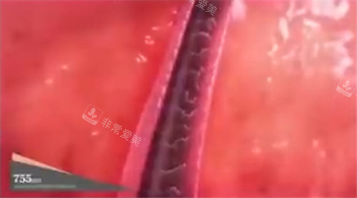 titanium鈦提升755波長(zhǎng)