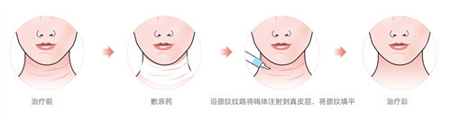 注射去颈纹流程图 注射去颈纹流程图