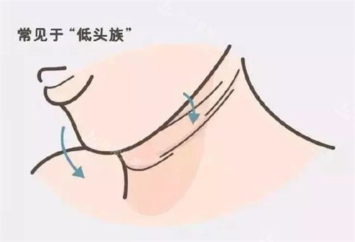 姿势错误导致的颈纹图 姿势错误导致的颈纹图