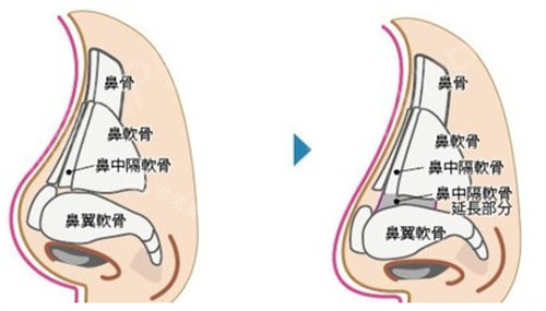 鼻中隔软骨延长术展示图