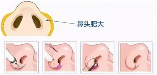 鼻翼縮小手術(shù)流程圖