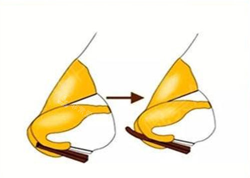 隆鼻手術(shù)前前后對(duì)比圖