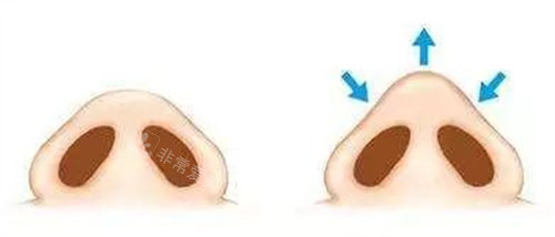 鼻頭整形前后對(duì)比圖