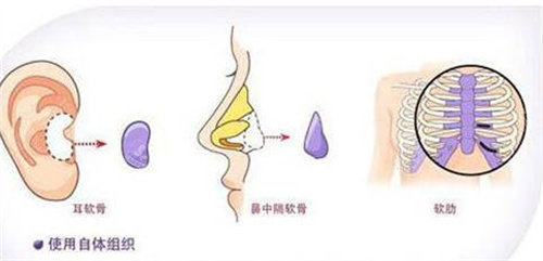 自體軟骨隆鼻流程圖