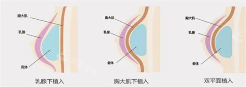 隆胸方式图