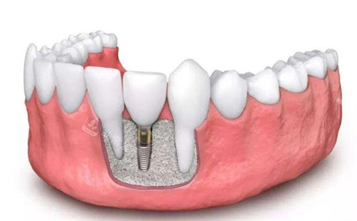 种植牙动画解剖图