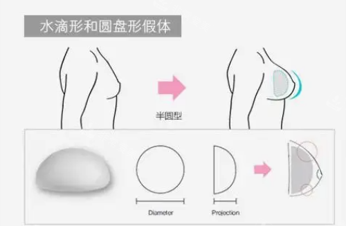 假體示意圖