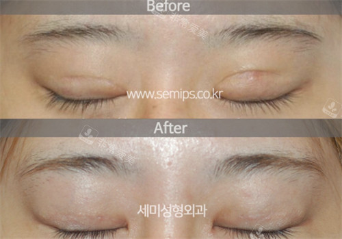韩国世美整形外科双眼皮疤痕修复对比