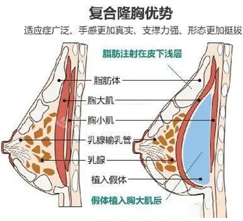 复合隆胸手术方式图