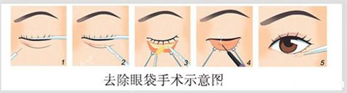 祛眼袋手術(shù)示意圖 祛眼袋手術(shù)示意圖