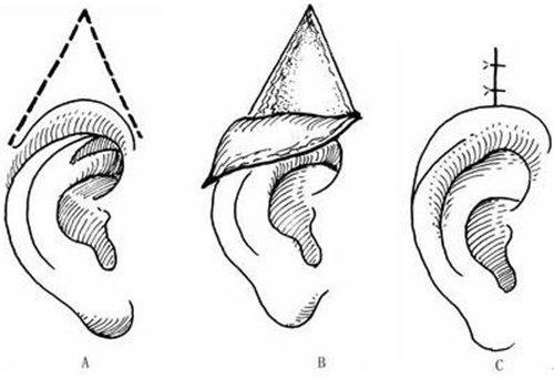 耳朵整形示意图