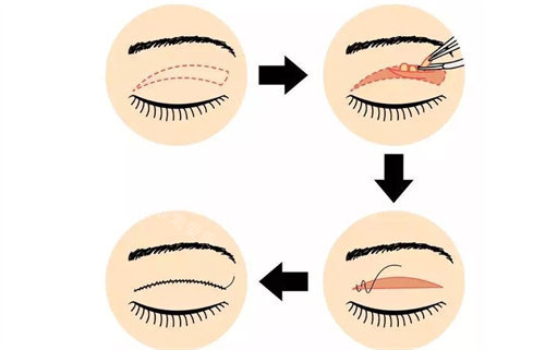 全切雙眼皮術(shù)式展示圖