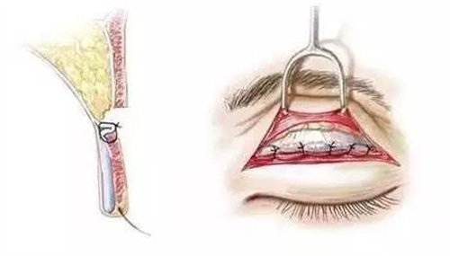 双眼皮手术切口展示图