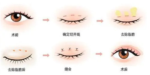 全切雙眼皮流程圖 全切雙眼皮流程圖