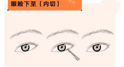 眼瞼下至內(nèi)切法示意圖 眼瞼下至內(nèi)切法示意圖