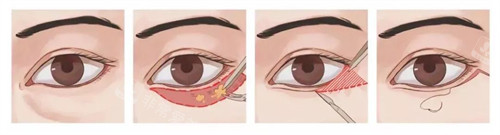 眼瞼下至手術(shù)過程圖 眼瞼下至手術(shù)過程圖