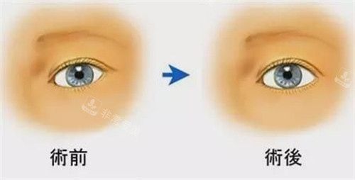 眼瞼下至術(shù)前術(shù)后對比圖 眼瞼下至術(shù)前術(shù)后對比圖