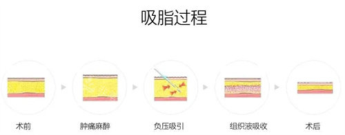 吸脂过程展示图