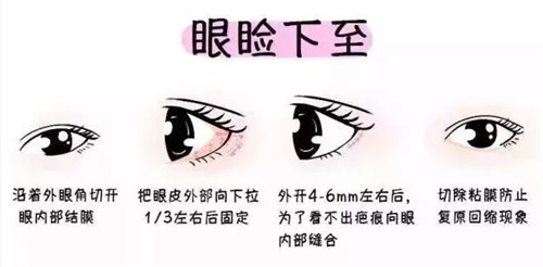 眼瞼下至外切示意圖 眼瞼下至外切示意圖