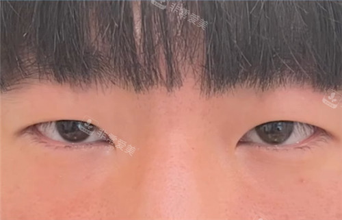 韓國EH愛護整形外科眼部整形術(shù)前 韓國EH愛護整形外科眼部整形術(shù)前