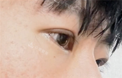 韓國EH愛護整形外科眼部整形術(shù)后1個月 韓國EH愛護整形外科眼部整形術(shù)后1個月