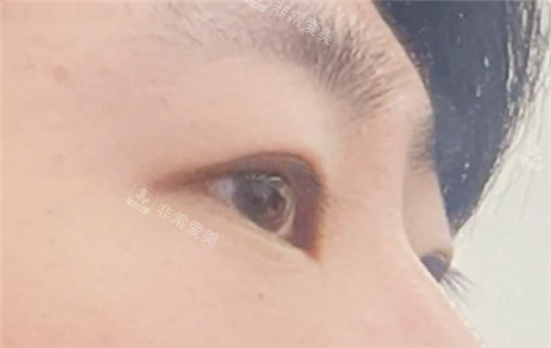 韓國EH愛護整形外科眼部整形術(shù)后圖 韓國EH愛護整形外科眼部整形術(shù)后圖